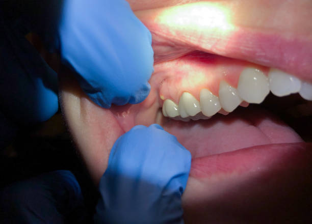 Best Emergency Gum Pain Relief  in Ste Genevieve, MO