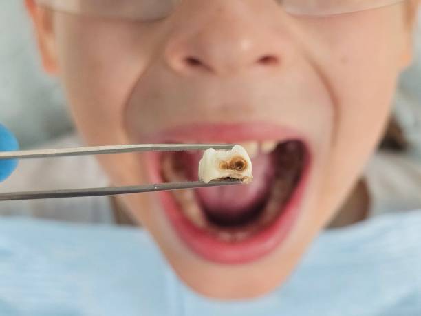 Best Knocked-Out Tooth Emergency  in Ste Genevieve, MO